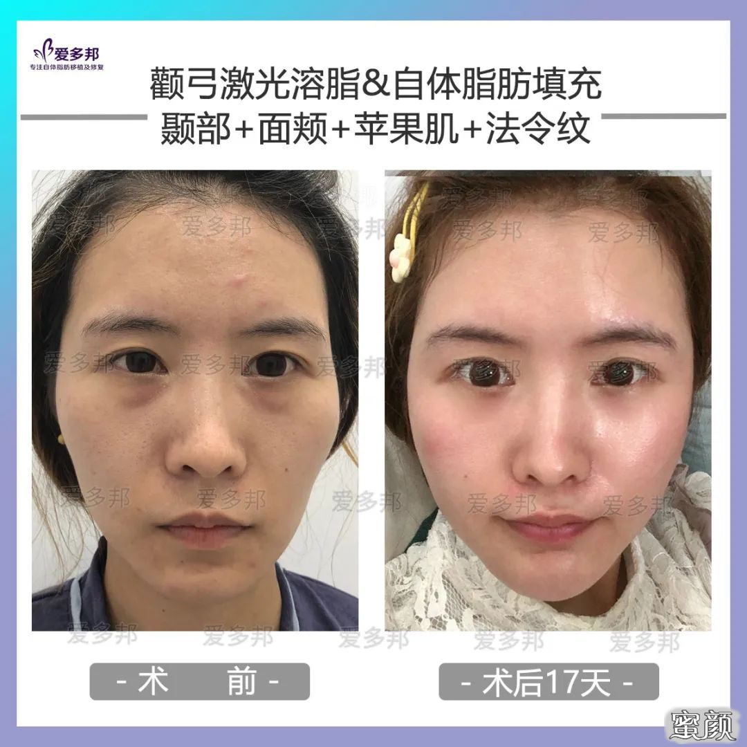 https://img.yiyiaimei.com/mnt/timg/200611/114S0AU-9.jpg 案例图片
