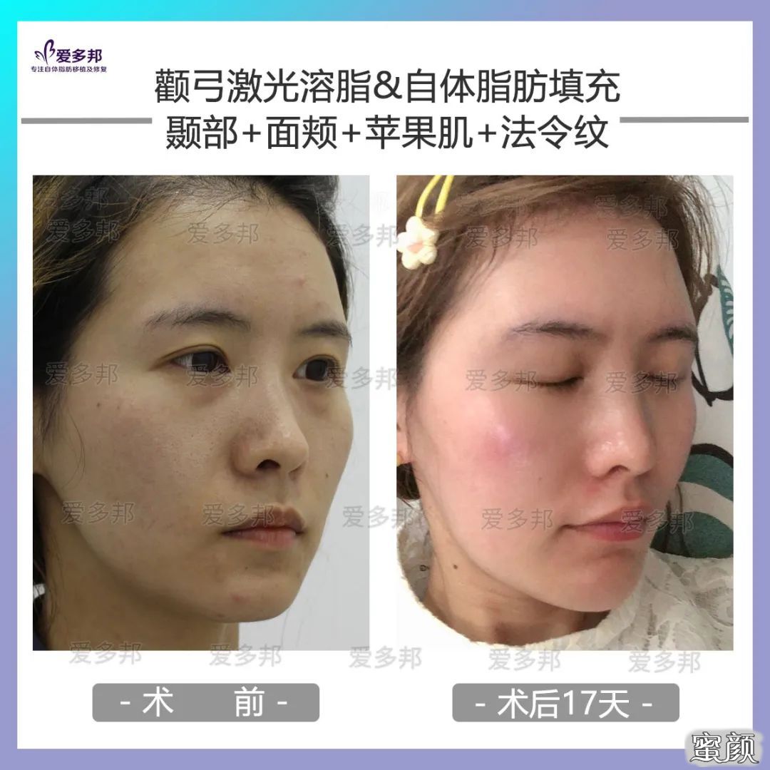 https://img.yiyiaimei.com/mnt/timg/200611/114S135L-10.jpg 案例图片