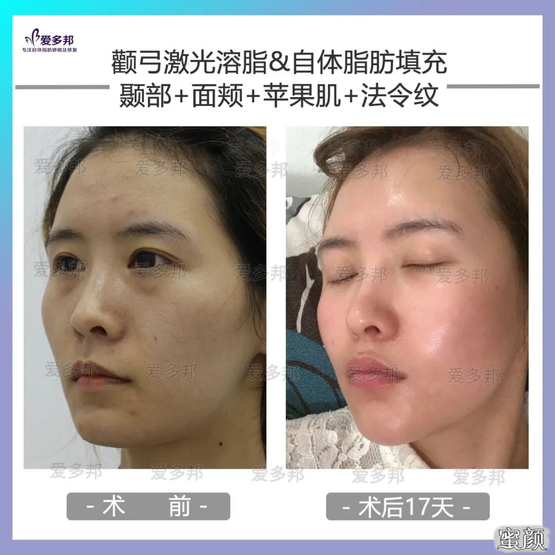 https://img.yiyiaimei.com/mnt/timg/200611/114S21632-11.jpg 案例图片