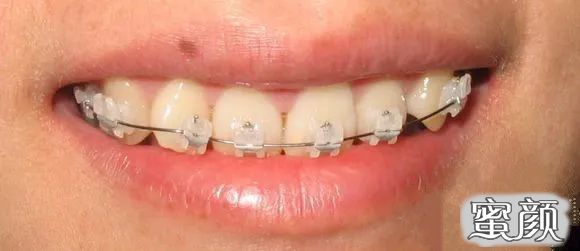 https://img.yiyiaimei.com/mnt/timg/200620/13223S5Z-4.jpg 案例图片