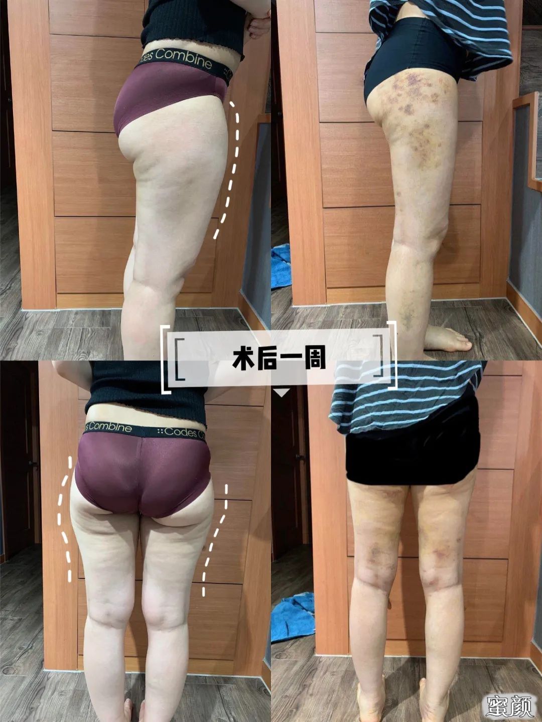 https://img.yiyiaimei.com/mnt/timg/200626/1115302601-7.jpg 案例图片