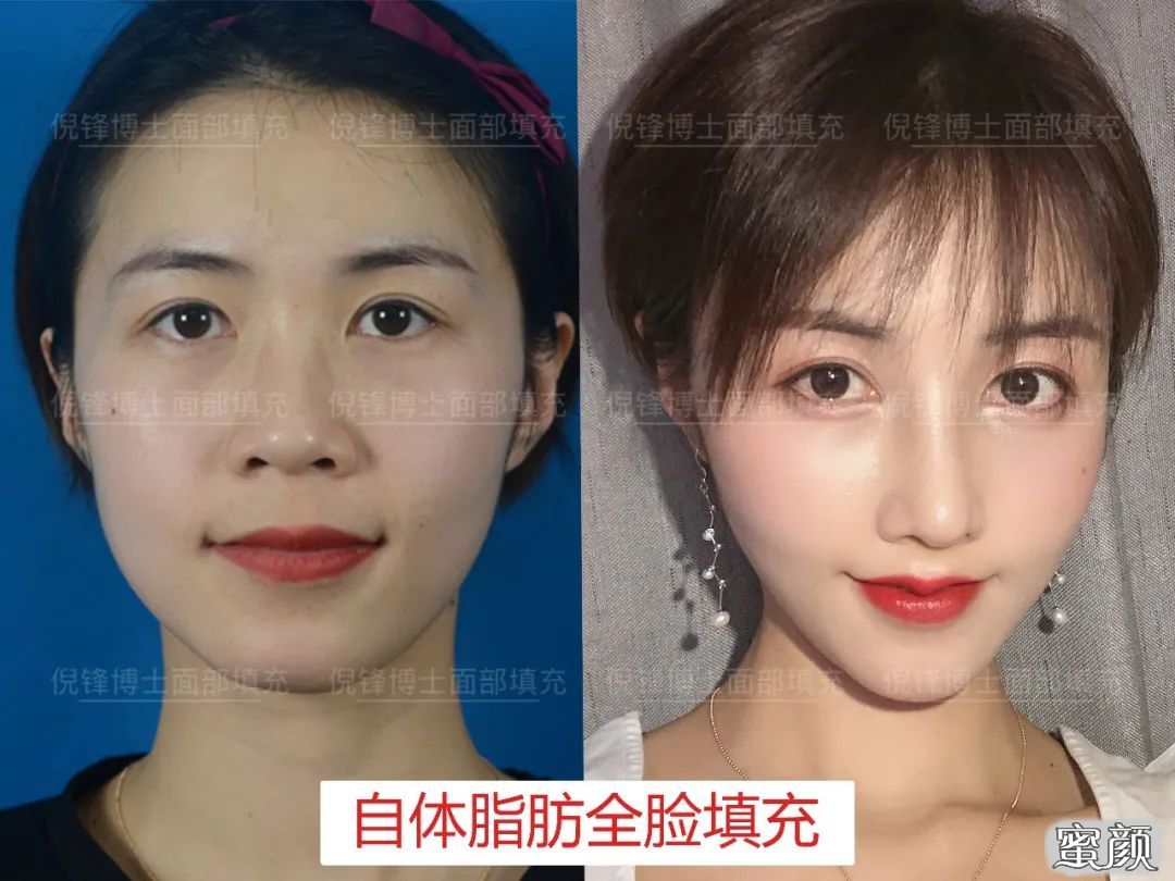 https://img.yiyiaimei.com/mnt/timg/200718/11393H548-2.jpg 案例图片