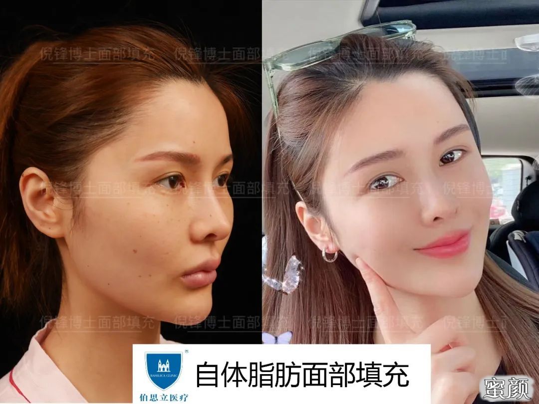 https://img.yiyiaimei.com/mnt/timg/200718/11393U429-3.jpg 案例图片