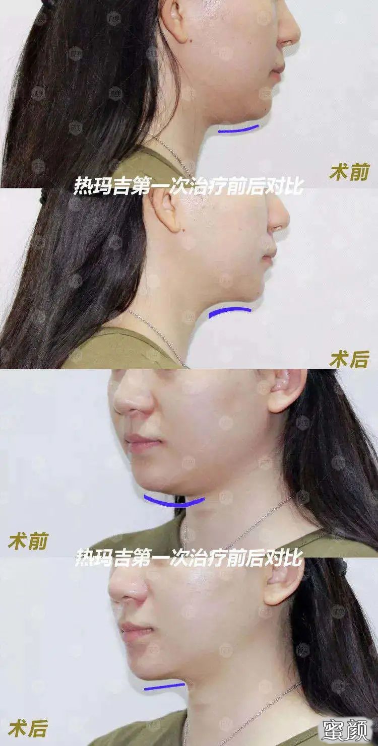 https://img.yiyiaimei.com/mnt/timg/200722/1614091110-8.jpg 案例图片