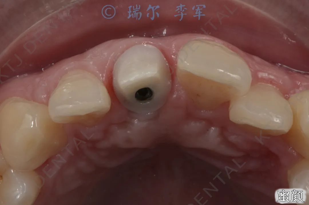 https://img.yiyiaimei.com/mnt/timg/200725/113G43O6-14.jpg 案例图片