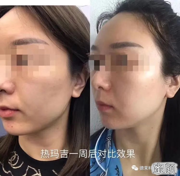 https://img.yiyiaimei.com/mnt/timg/200804/110HG015-2.jpg 案例图片
