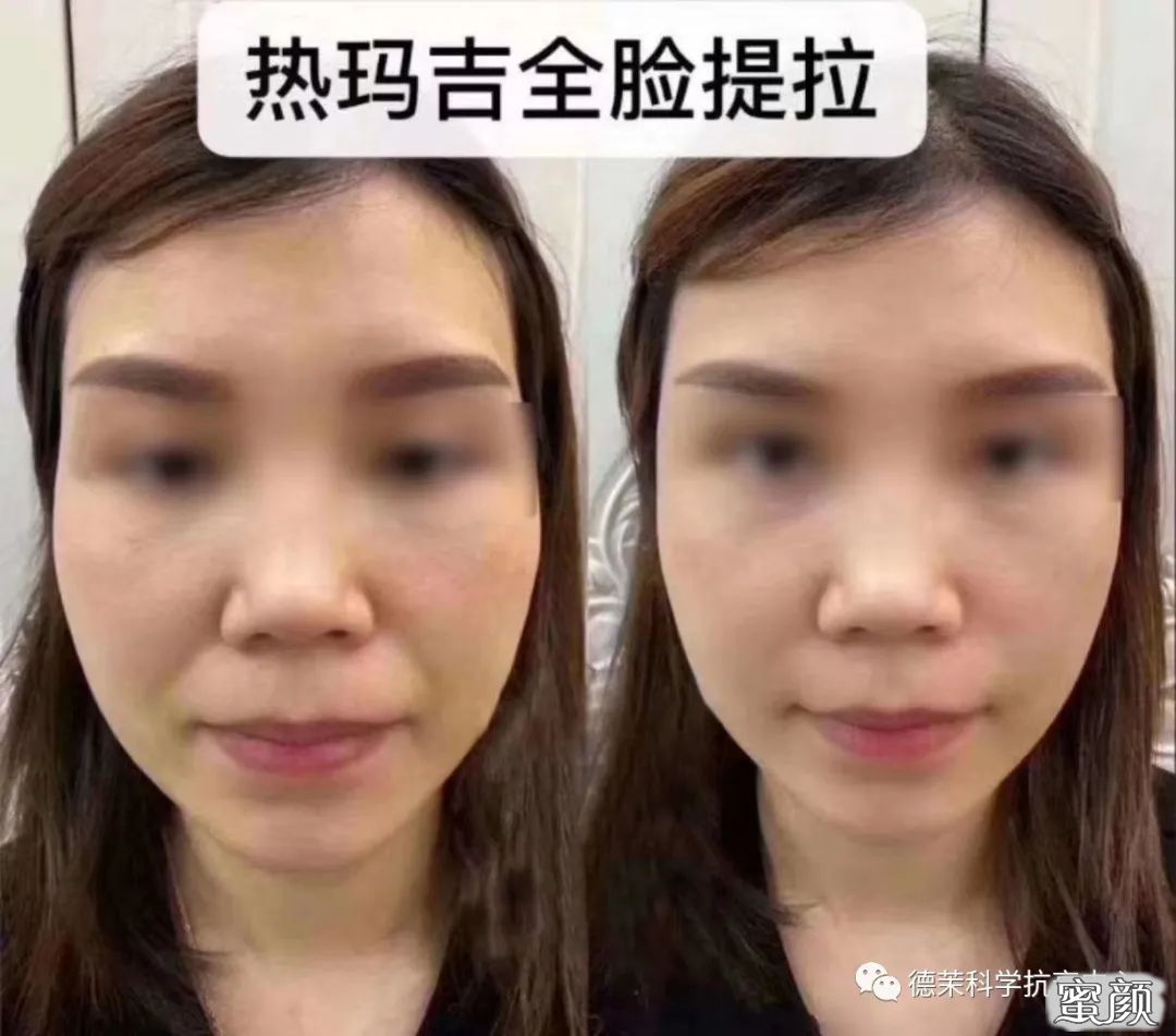 https://img.yiyiaimei.com/mnt/timg/200804/110I264L-8.jpg 案例图片