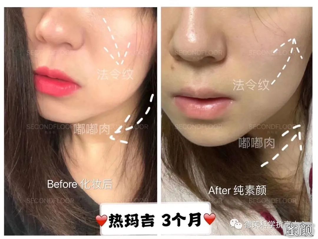 https://img.yiyiaimei.com/mnt/timg/200804/110I94647-14.jpg 案例图片
