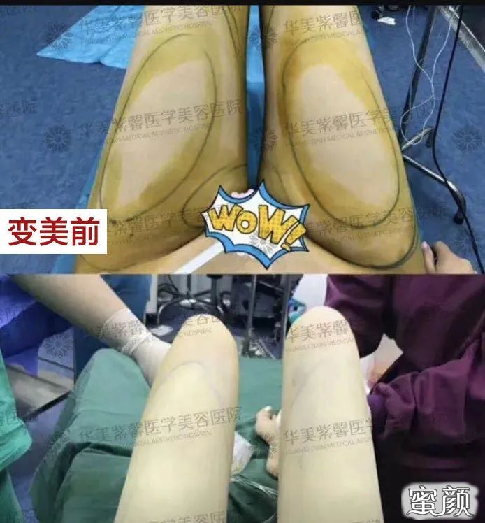https://img.yiyiaimei.com/mnt/timg/200806/110PK962-3.jpg 案例图片