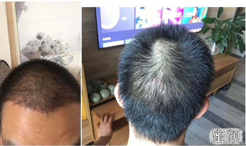 https://img.yiyiaimei.com/mnt/timg/200810/1239354H0-4.jpg 案例图片
