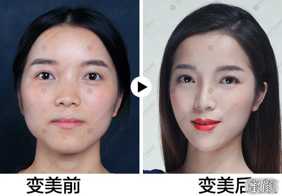 https://img.yiyiaimei.com/mnt/timg/200812/1052562052-0.jpg 案例图片