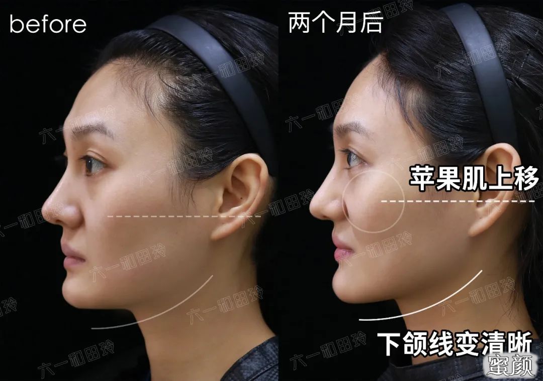 https://img.yiyiaimei.com/mnt/timg/200813/13111550L-0.jpg 案例图片
