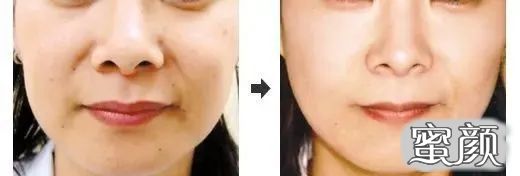 https://img.yiyiaimei.com/mnt/timg/200814/1150501W0-4.jpg 案例图片