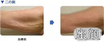 https://img.yiyiaimei.com/mnt/timg/200814/1150513044-6.jpg 案例图片