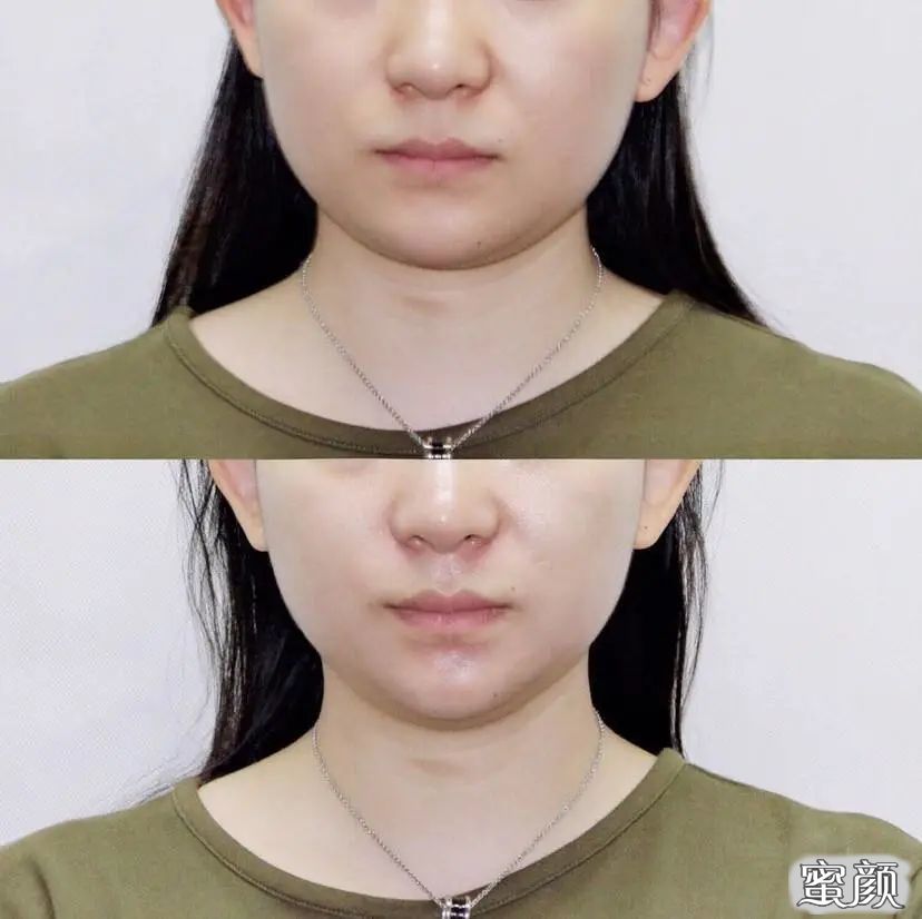 https://img.yiyiaimei.com/mnt/timg/200814/1213415T6-2.jpg 案例图片