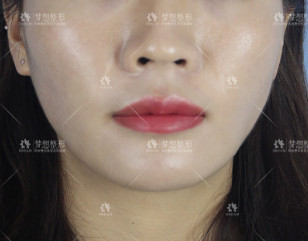 https://img.yiyiaimei.com/mnt/timg/200816/1133461E4-2.jpg 案例图片