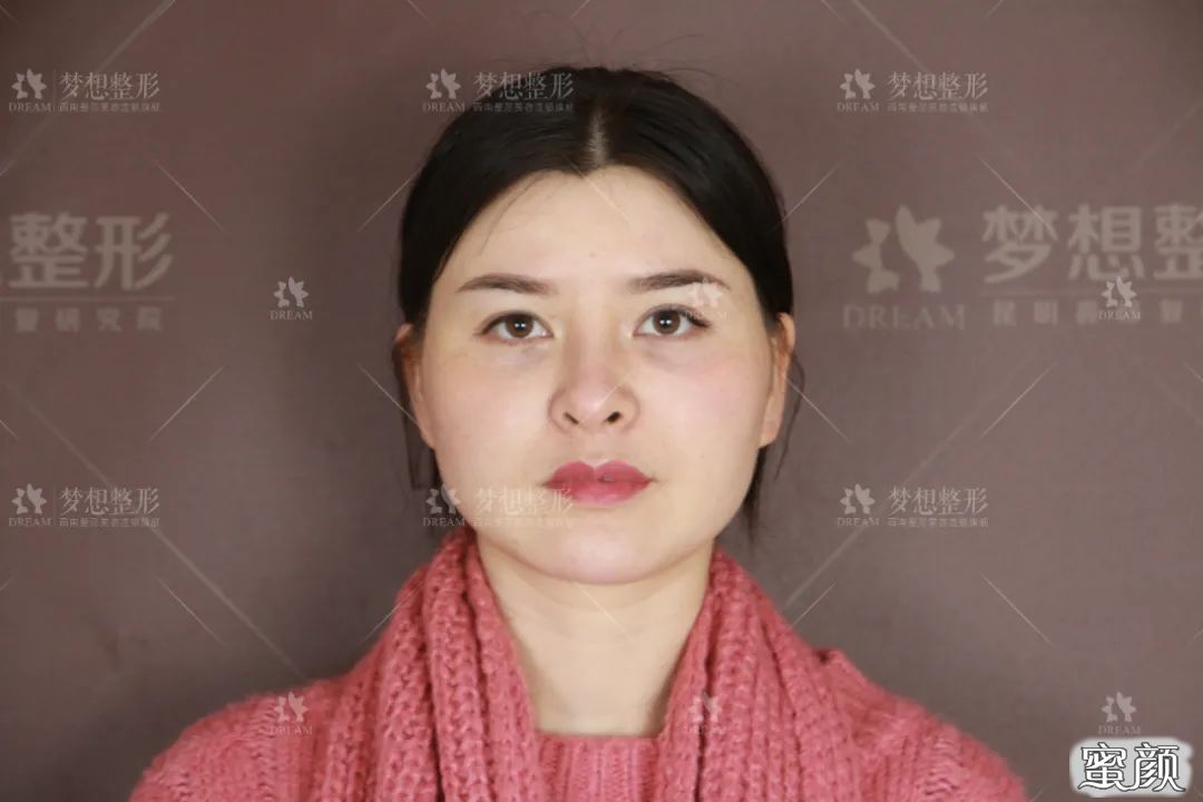 https://img.yiyiaimei.com/mnt/timg/200816/1133493N4-3.jpg 案例图片