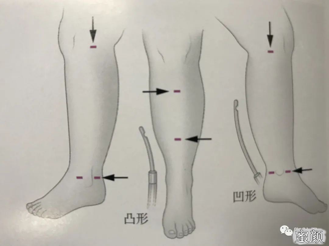 https://img.yiyiaimei.com/mnt/timg/200821/121J232W-1.jpg 案例图片