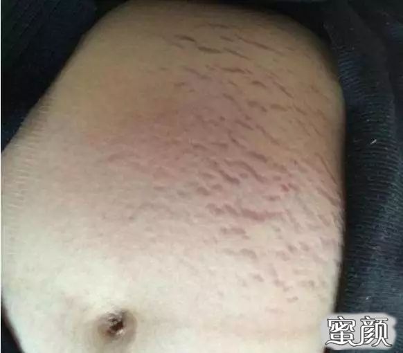 https://img.yiyiaimei.com/mnt/timg/200822/14563U122-5.jpg 案例图片