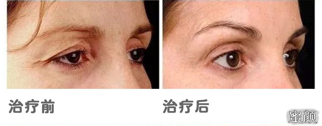 https://img.yiyiaimei.com/mnt/timg/200824/14404L127-8.jpg 案例图片