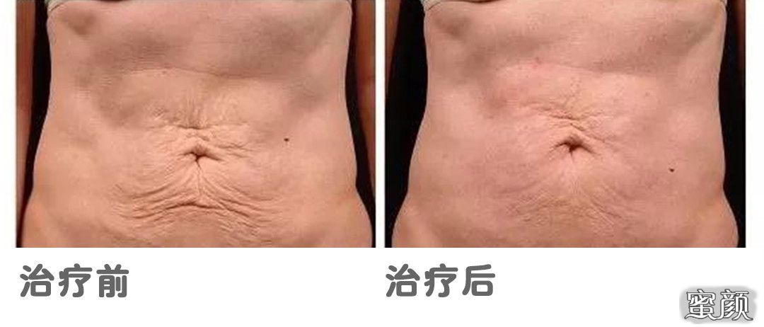 https://img.yiyiaimei.com/mnt/timg/200824/14405052F-9.jpg 案例图片