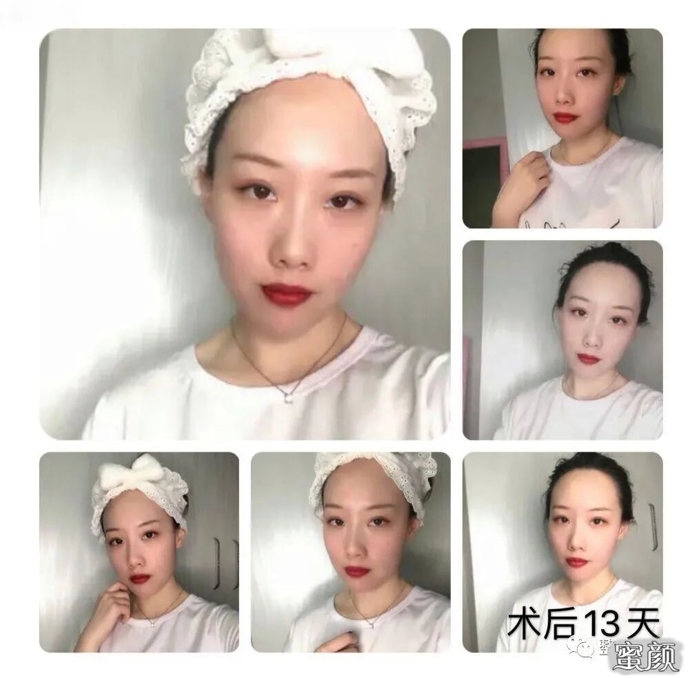 https://img.yiyiaimei.com/mnt/timg/200829/13011GV1-2.jpg 案例图片
