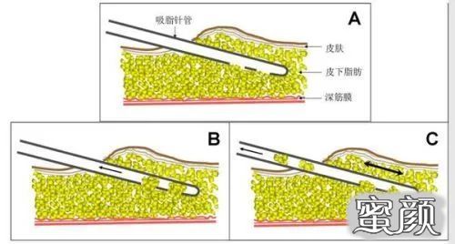 https://img.yiyiaimei.com/mnt/timg/200929/1206454B4-11.jpg 案例图片