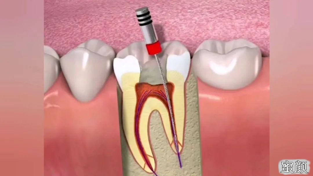 「科普」只是牙疼,为什么医生要我做根管治疗