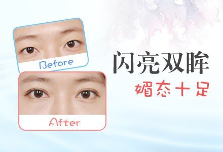 重庆微创双眼皮手术-