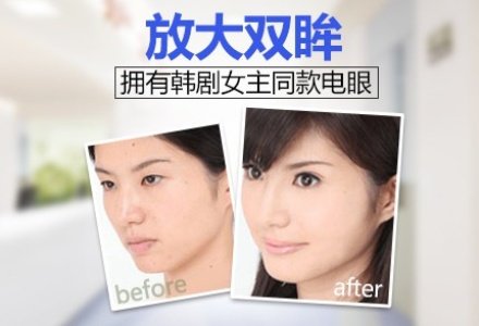 成都韩式三点双眼皮-