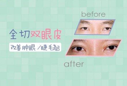 郑州全切双眼皮-