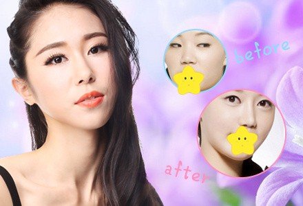 长沙逸美玻尿酸注射隆鼻-