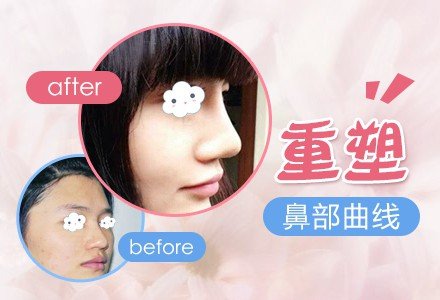 成都瑞蓝玻尿酸隆鼻-