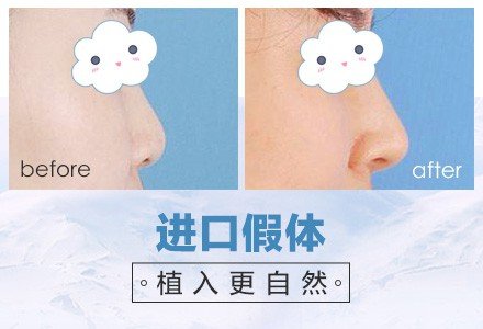 西安硅胶假体隆鼻-