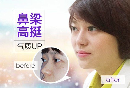 成都硅胶假体隆鼻-