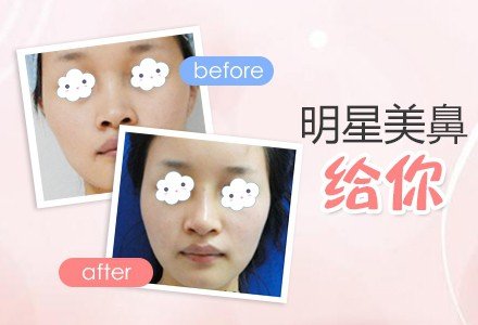 台州康宁硅胶假体隆鼻-
