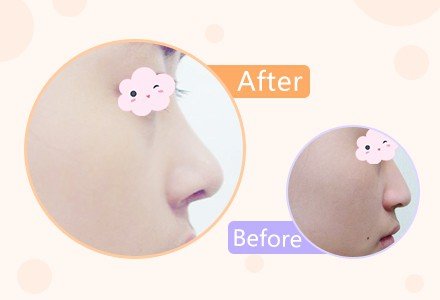 新疆硅胶假体隆鼻-