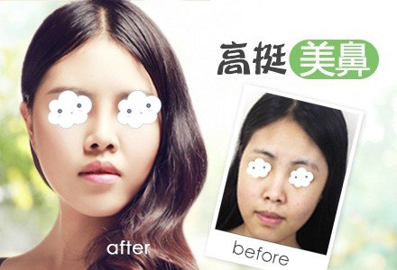 成都硅胶假体隆鼻-