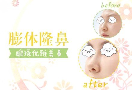 郑州进口膨体隆鼻-