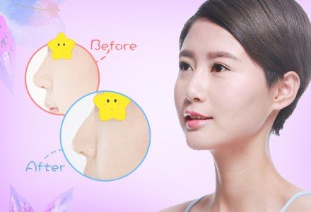 长春伊婉玻尿酸隆鼻-