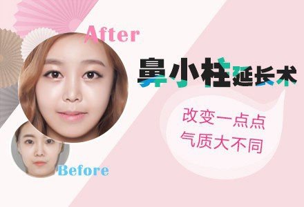 郑州鼻整形鼻小柱延长术-