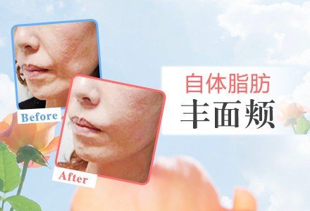 成都自体脂肪注射丰面颊-