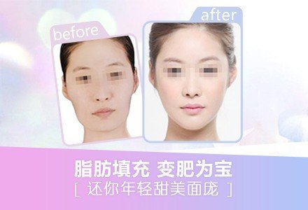 成都全脸脂肪填充-