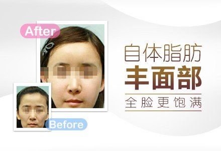 重庆自体脂肪丰全脸-