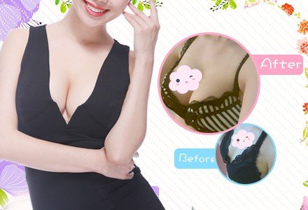 北京康宁硅胶假体隆胸-