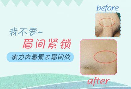 杭州衡力肉毒素注射去眉间纹-