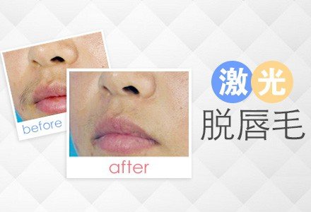 遂宁激光脱唇毛-