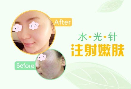 西安水光针注射嫩肤-