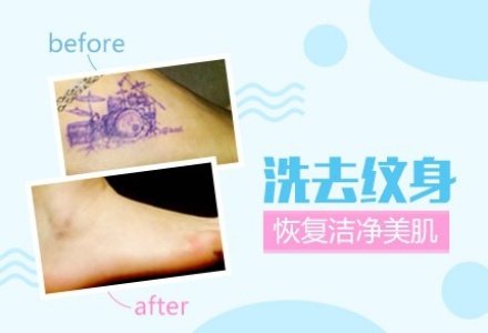 深圳激光洗纹身-